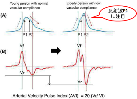 AVI （Arterial Velocity pulse Index)の原理